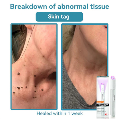 Tiworld™ All-in-One Laser Eraser Pen(Powered by CO₂ laser technology – effectively removes moles, warts, skin tags, pigmentation spots, and other skin imperfections)