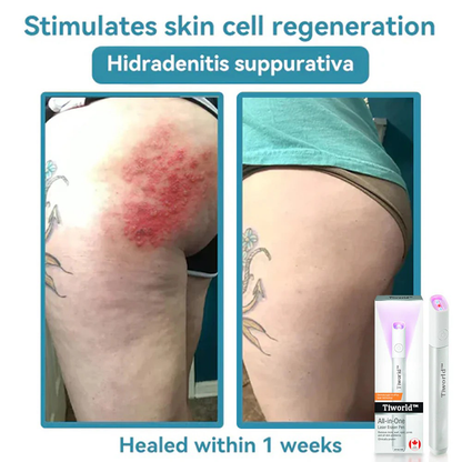 Tiworld™ All-in-One Laser Eraser Pen(Powered by CO₂ laser technology – effectively removes moles, warts, skin tags, pigmentation spots, and other skin imperfections)