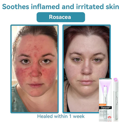 Tiworld™ All-in-One Laser Eraser Pen(Powered by CO₂ laser technology – effectively removes moles, warts, skin tags, pigmentation spots, and other skin imperfections)