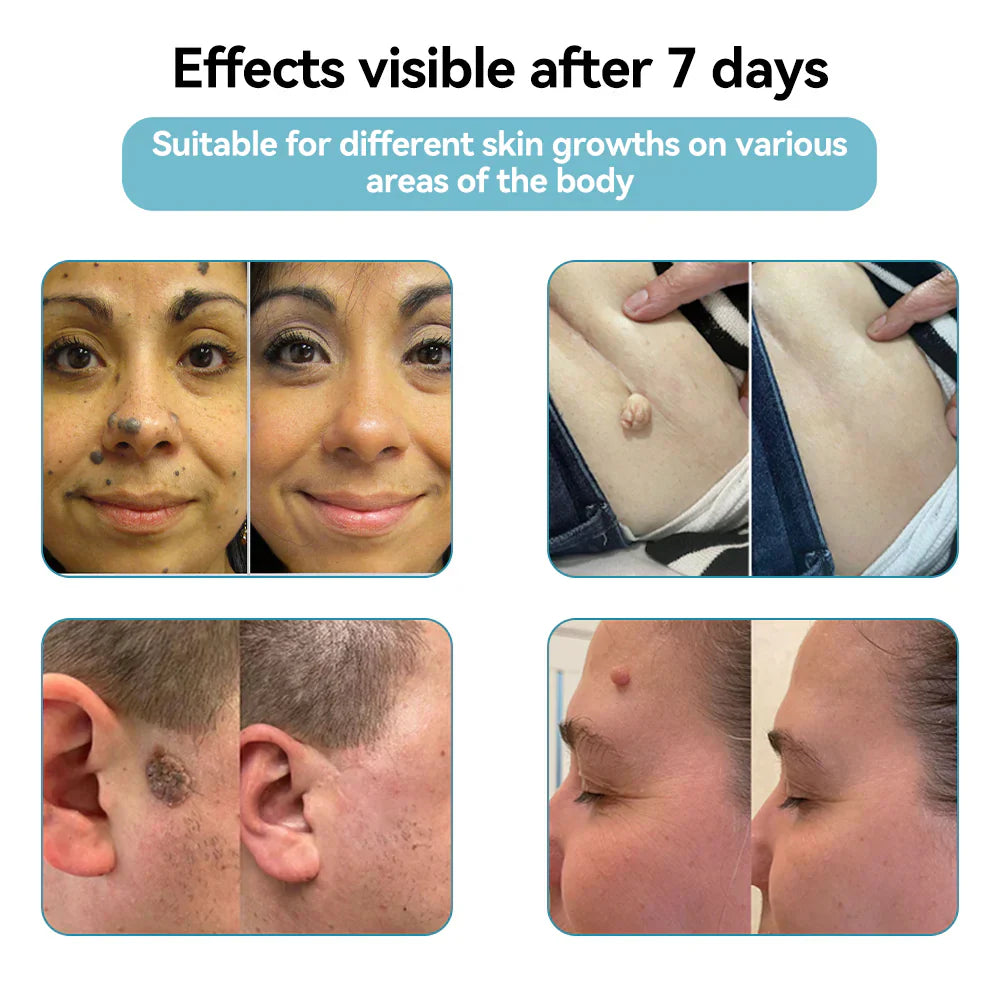 Tiworld™ All-in-One Laser Eraser Pen(Powered by CO₂ laser technology – effectively removes moles, warts, skin tags, pigmentation spots, and other skin imperfections)