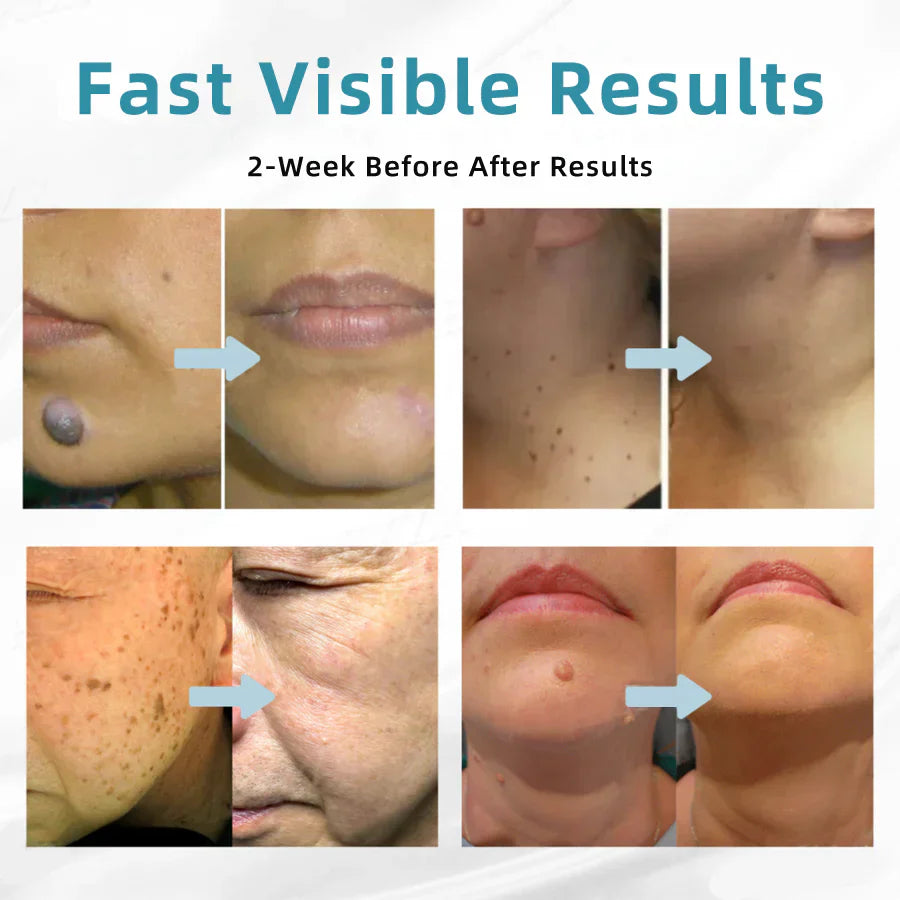 Tiworld™ All-in-One Laser Eraser Pen(Powered by CO₂ laser technology – effectively removes moles, warts, skin tags, pigmentation spots, and other skin imperfections)
