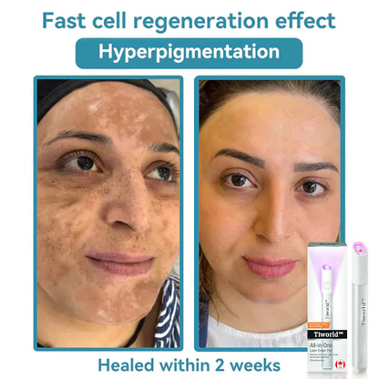 Tiworld™ All-in-One Laser Eraser Pen(Powered by CO₂ laser technology – effectively removes moles, warts, skin tags, pigmentation spots, and other skin imperfections)